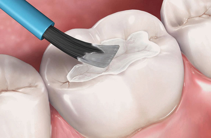 Phương Pháp Trám Răng Sealant