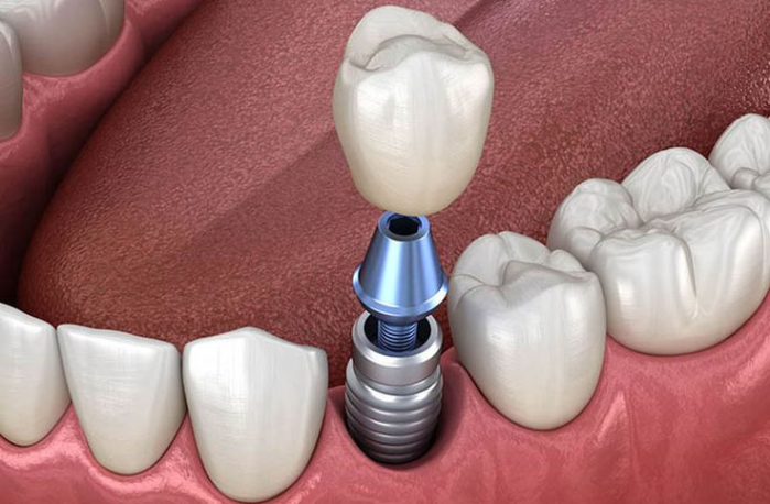 Cấy Ghép Implant Dành Cho Khách Việt Kiều?