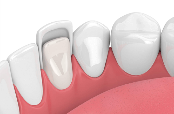D&aacute;n Sứ Veneer