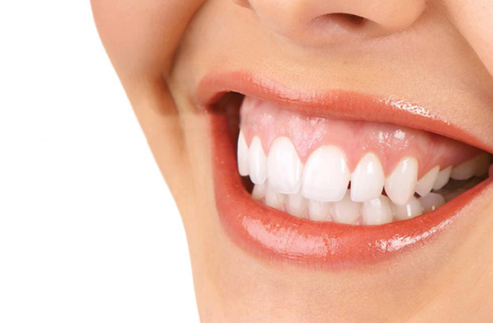 Cười Hở Lợi Là Gì?