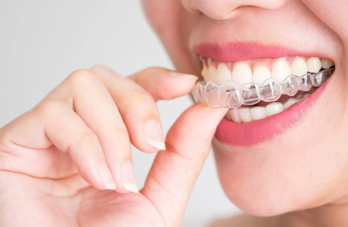 Cơ Chế Hoạt Động Của Niềng Răng Trong Suốt