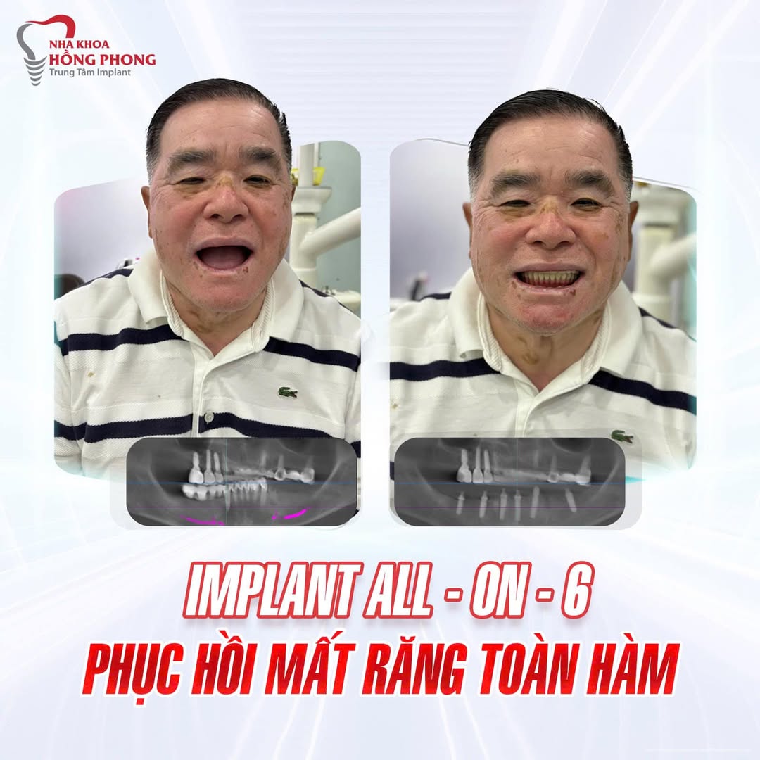 Hình ảnh Khách hàng trồng Implant tại Nha Khoa Hồng Phong