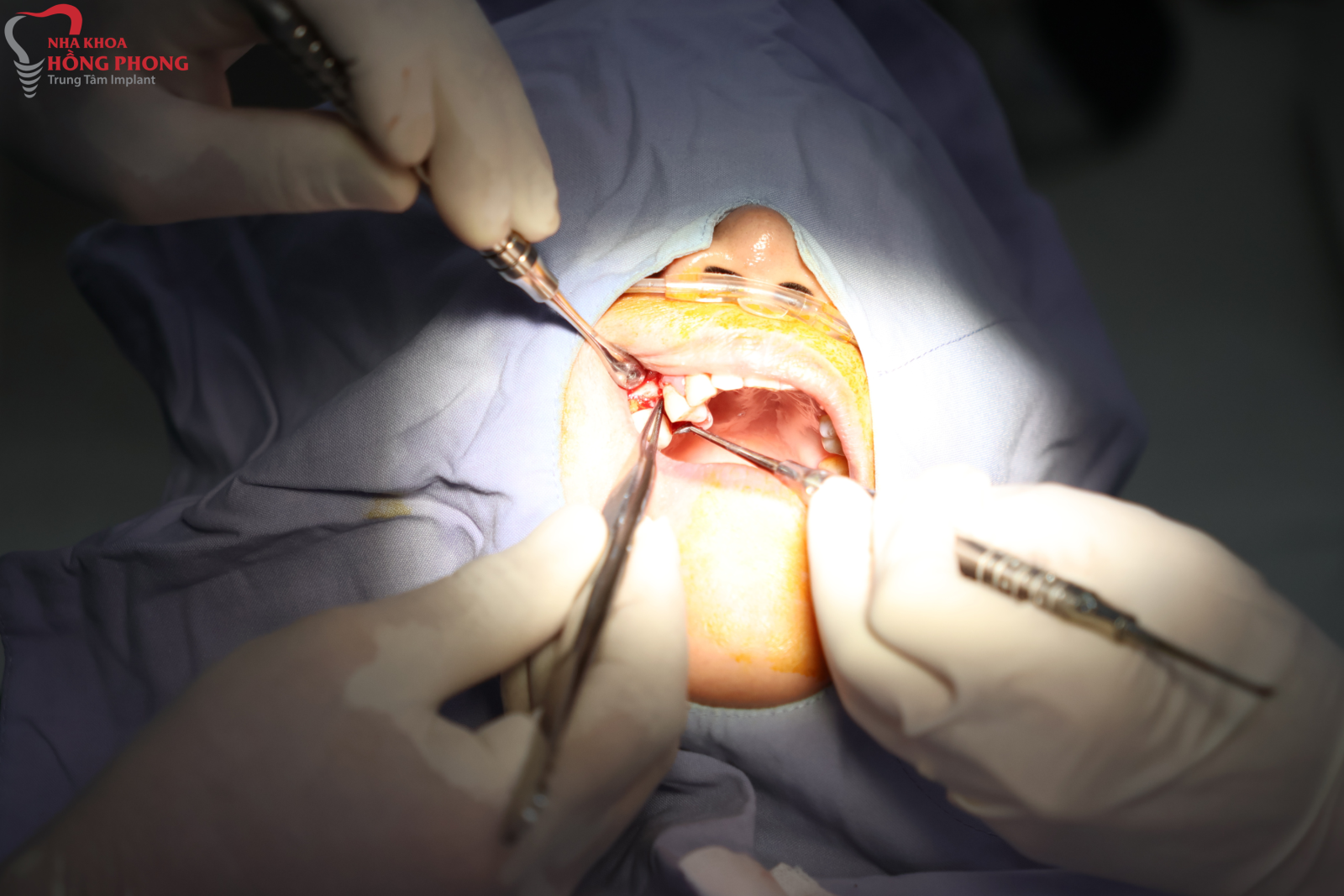 Phùng Xuân Hạnh Thực Hiện Thành Công Cấy Ghép Implant