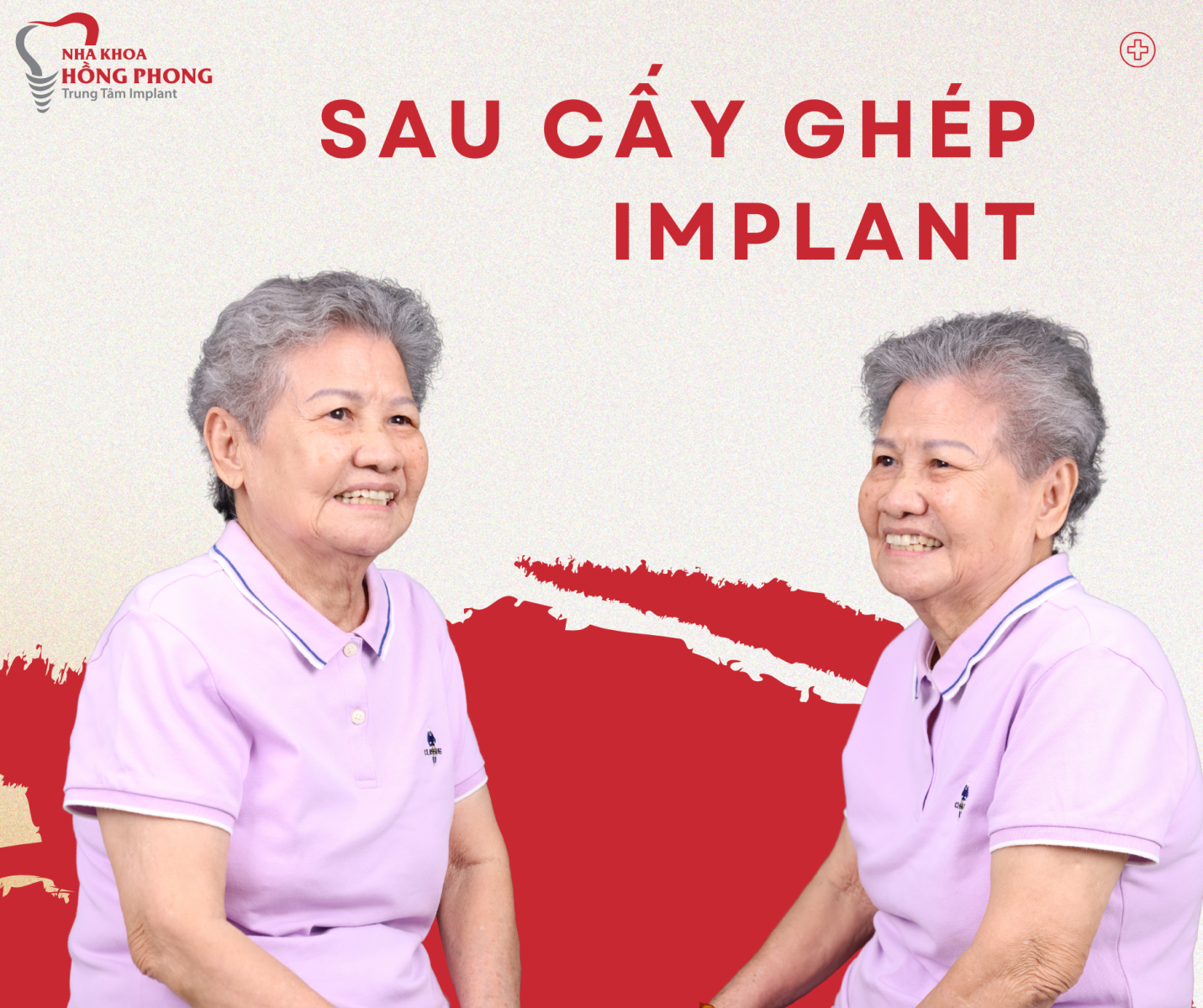 Cô Thúy Hòa Thực Hiện Thành Công Cấy Ghép 9 Trụ Implant