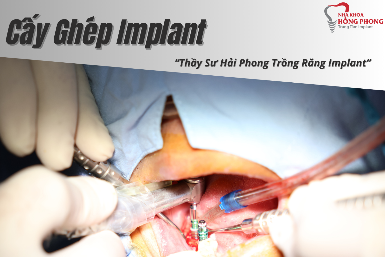 Thầy Sư Hải Phong Thực Hiện Thành Công Cấy Ghép Implant