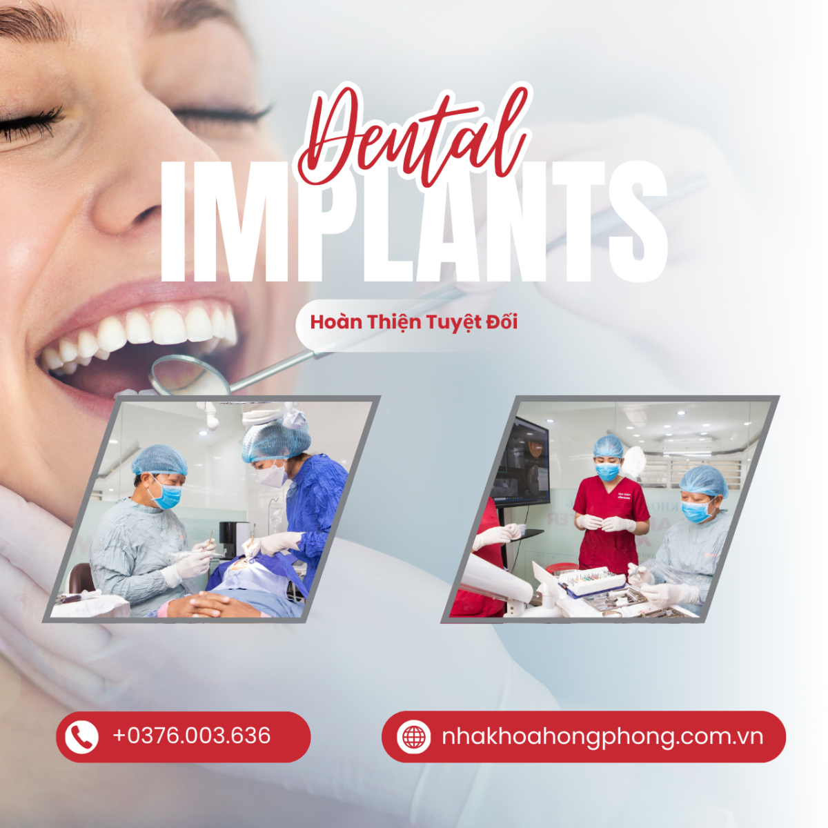 Địa Chỉ Trồng Răng Implant Tại TPHCM Uy Tín Và An Toàn