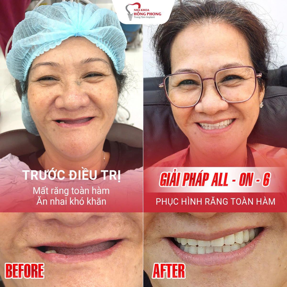 Hiệu Quả Trồng Răng Implant Tại Nha Khoa Hồng Phong