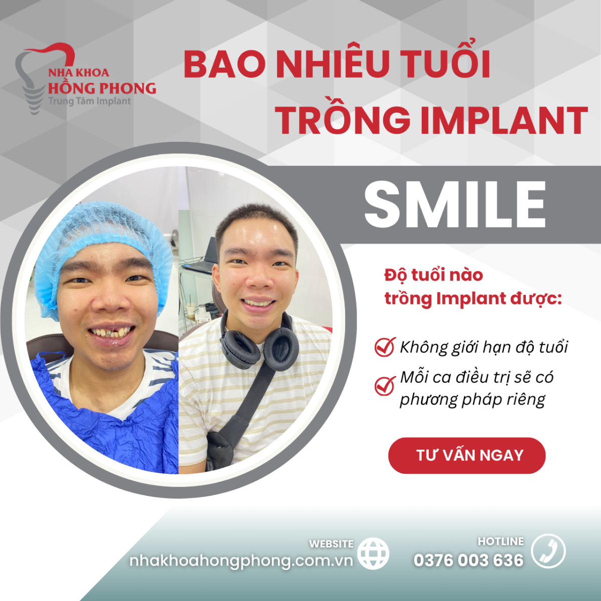 Bao Nhiêu Tuổi Thì Trồng Răng Implant Được?