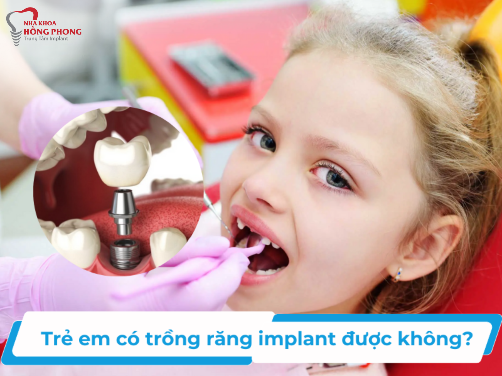 Bao Nhiêu Tuổi Thì Trồng Răng Implant Được?