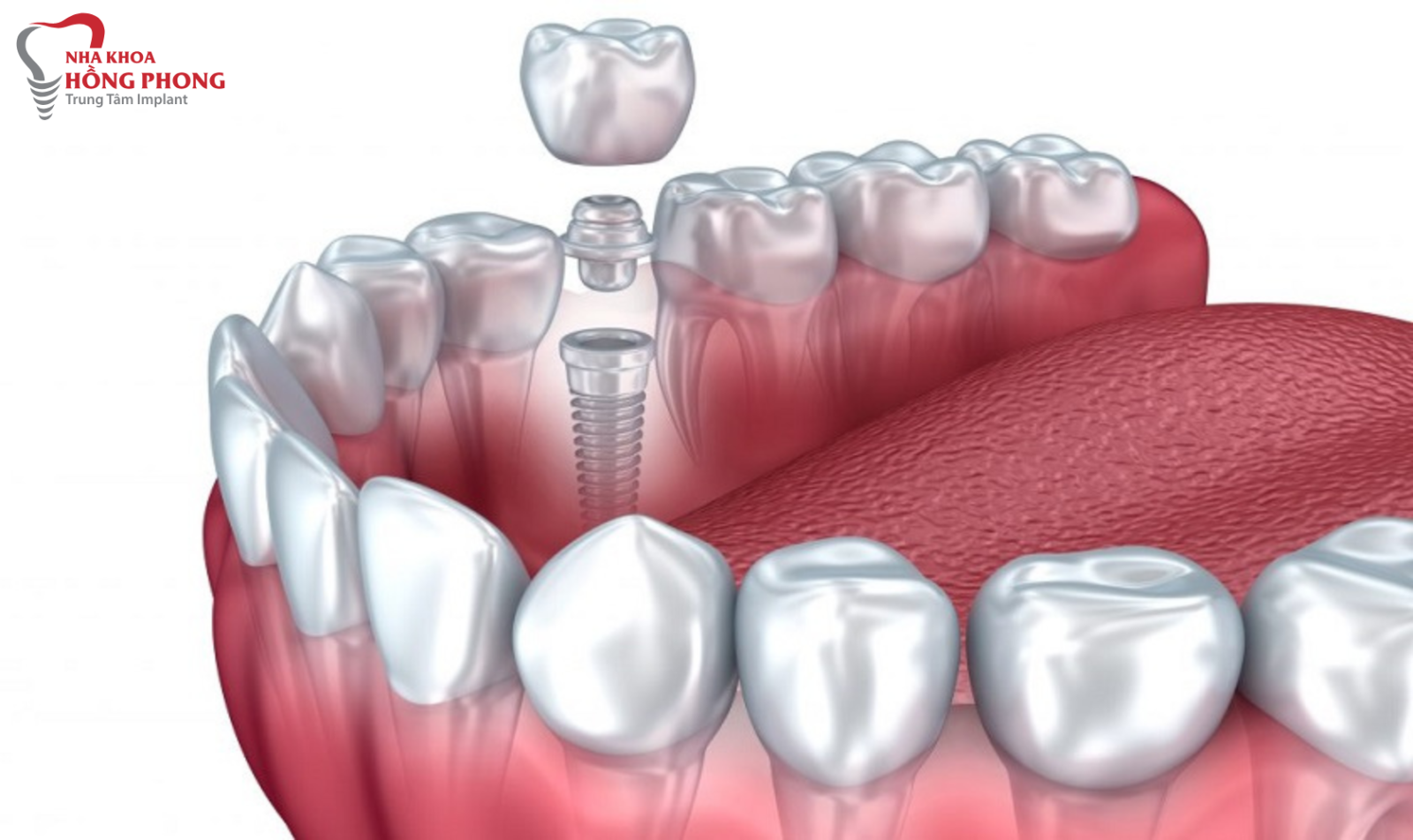 Bao Nhiêu Tuổi Thì Trồng Răng Implant Được?