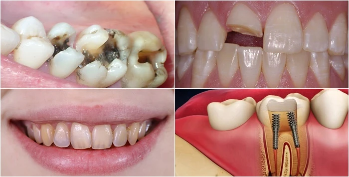 Tại Sao Cần Điều Trị Tủy Răng?