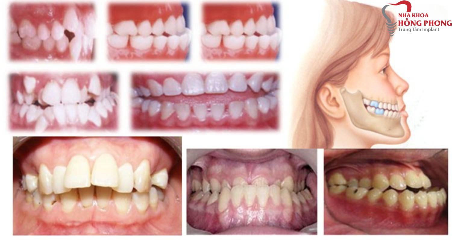 Những trường hợp không nên bọc răng sứ bạn cần biết
