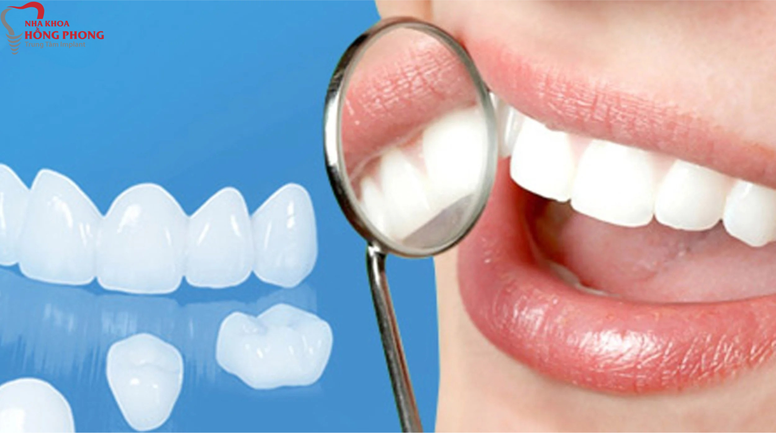 Có Nên Bọc Răng Sứ Không? Những Ai Nên Và Không Nên Bọc Răng Sứ?