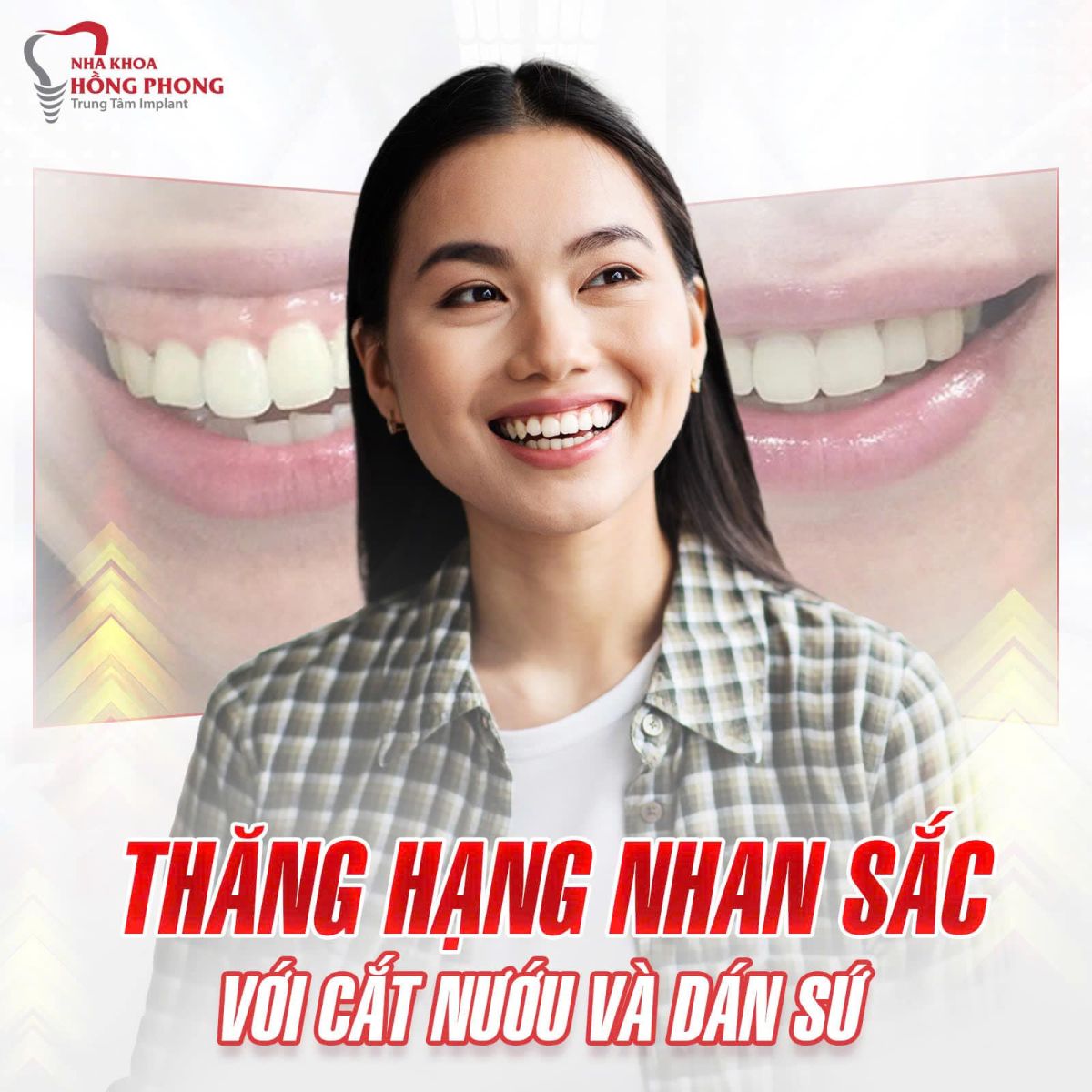 Nha Khoa Dán Sứ Veneer Tốt Nhất Quận 5 Tp.HCM