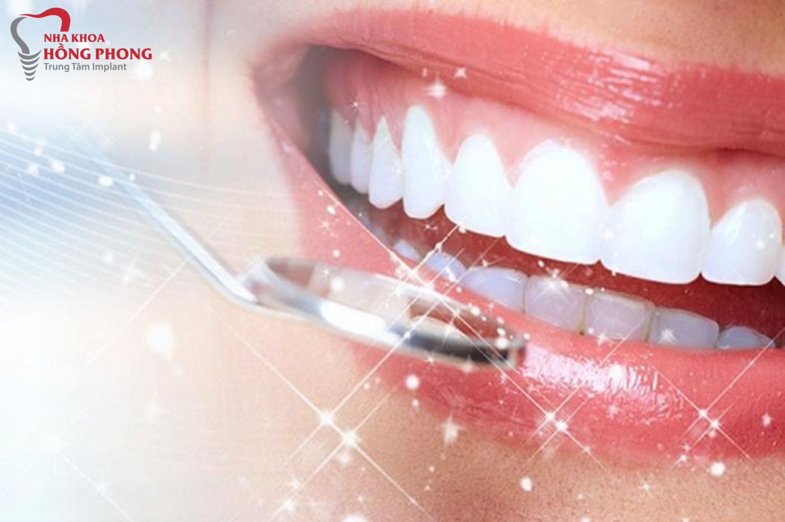 Nha Khoa Dán Sứ Veneer Tốt Nhất Quận 5 Tp.HCM