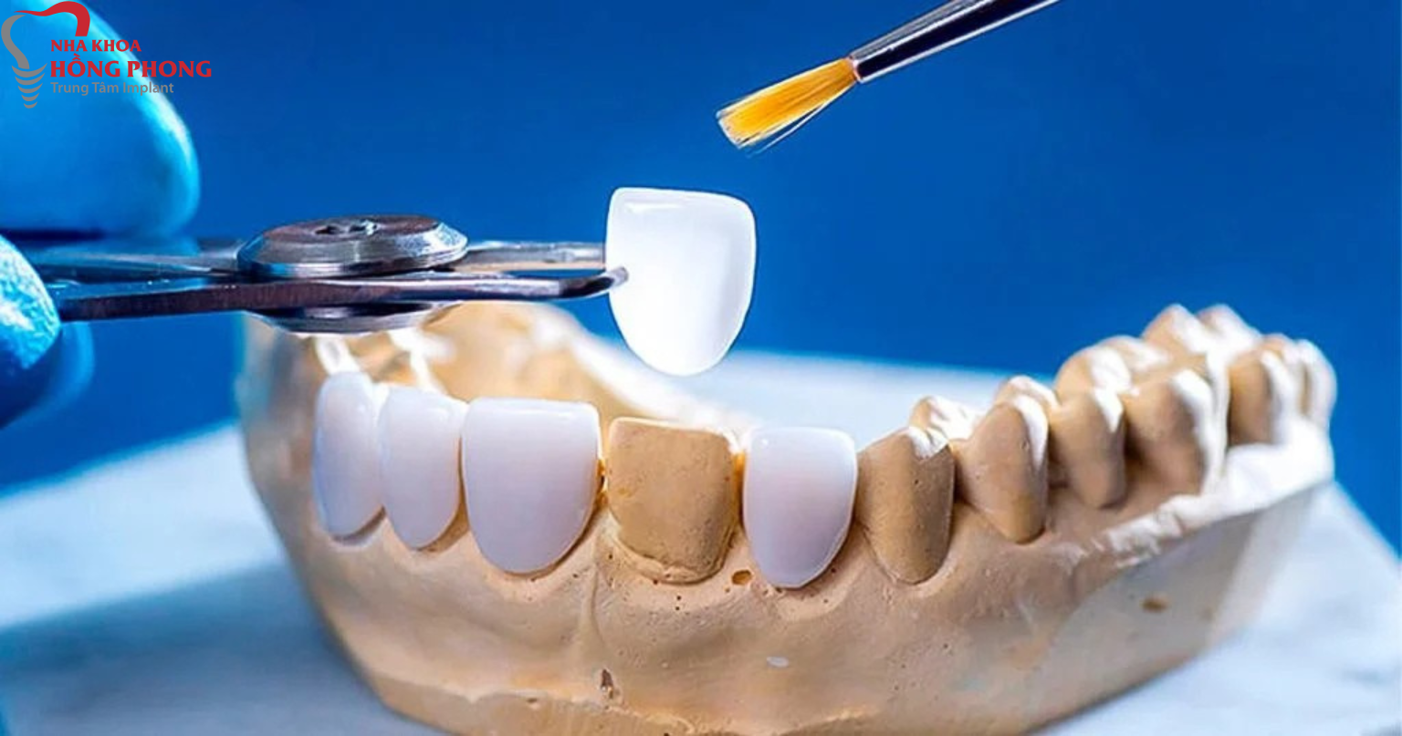 Nha Khoa Dán Sứ Veneer Tốt Nhất Quận 5 Tp.HCM