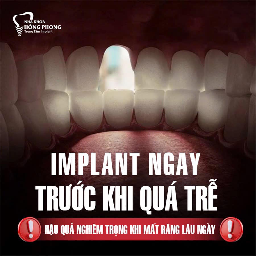 Hậu Quả Nghiêm Trọng Khi Mất Răng Lâu Ngày