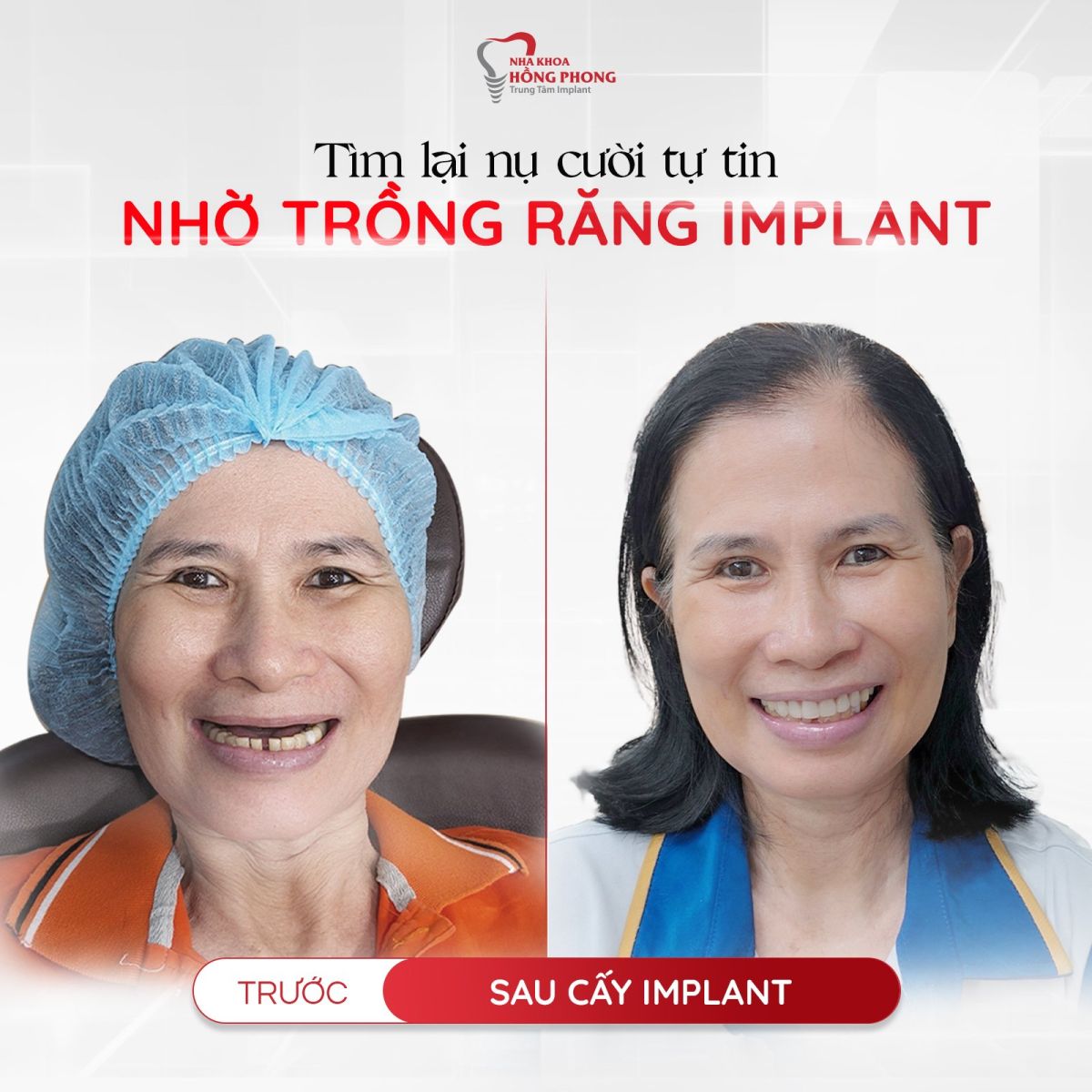 Cấy Ghép Implant - Giải Pháp Toàn Diện