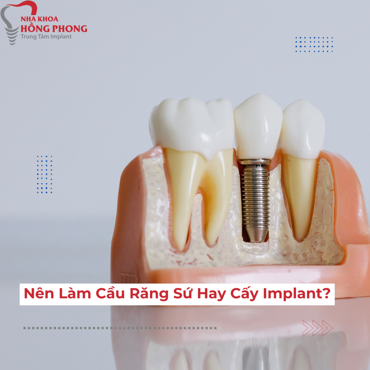 Nên Trồng Răng Bằng Cầu Răng Sứ Hay Cấy Implant
