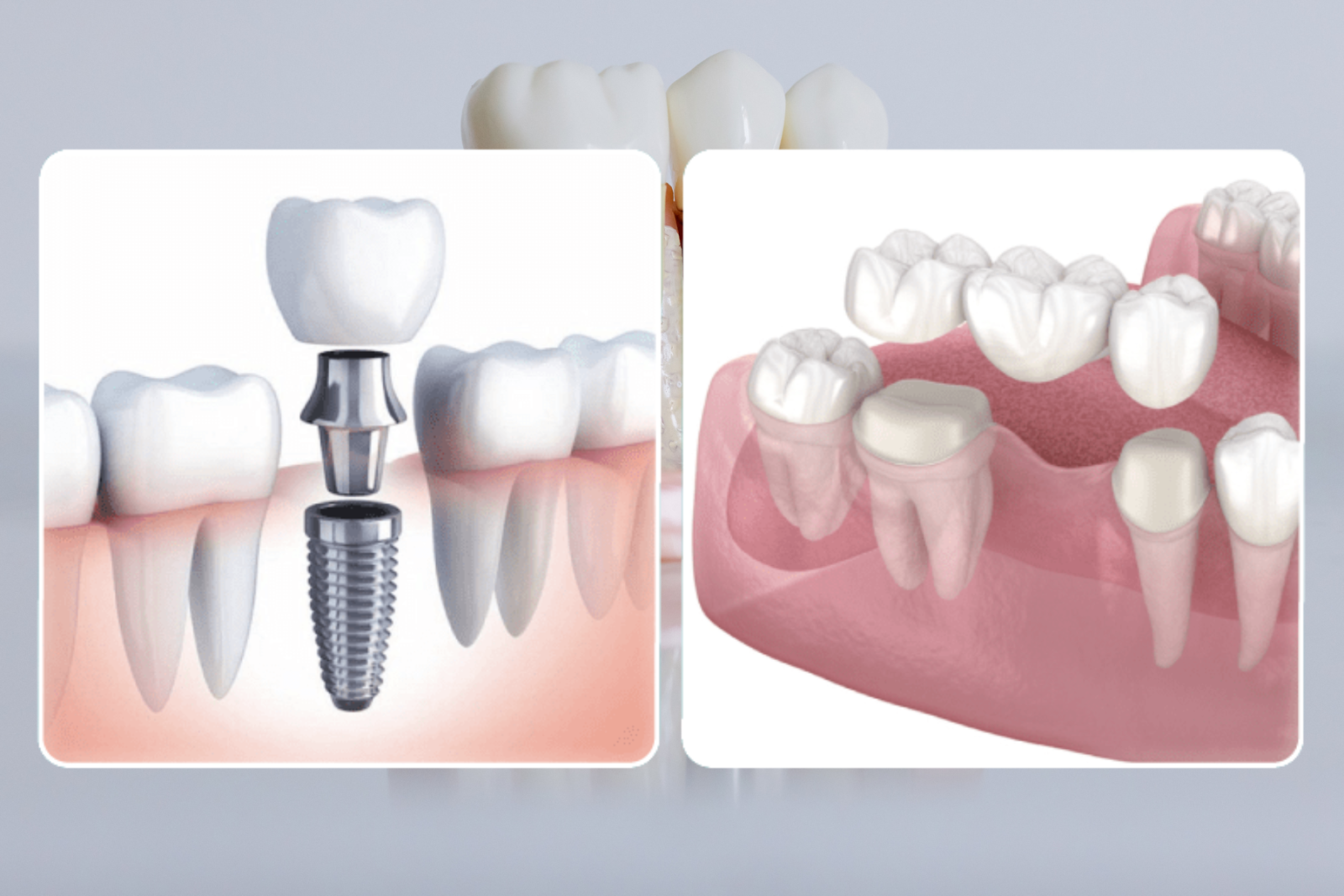 So Sánh Giữa Trồng Răng Sứ & Implant