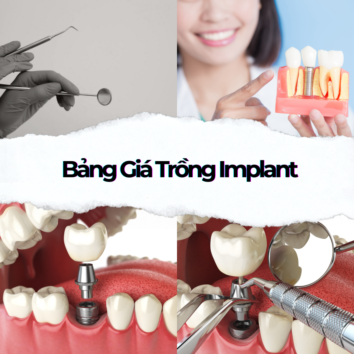 Trồng Răng Implant | Quy Trình & Bảng Giá Cấy Implant 2025