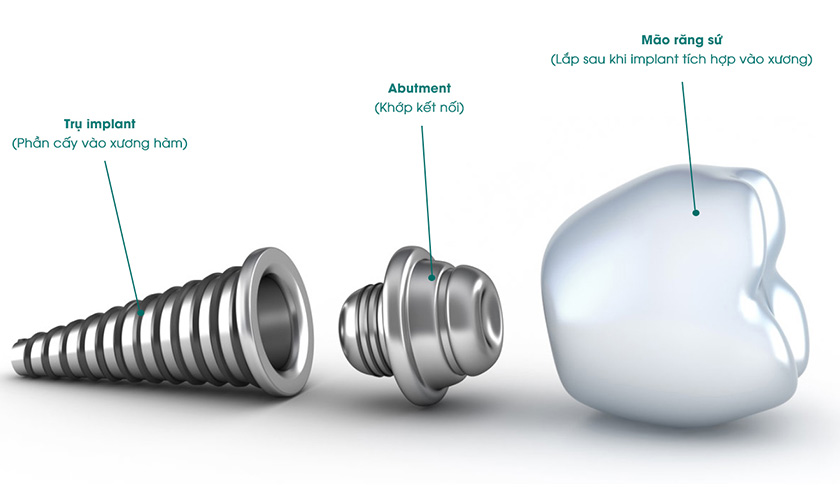 Cấu tạo của một răng implant