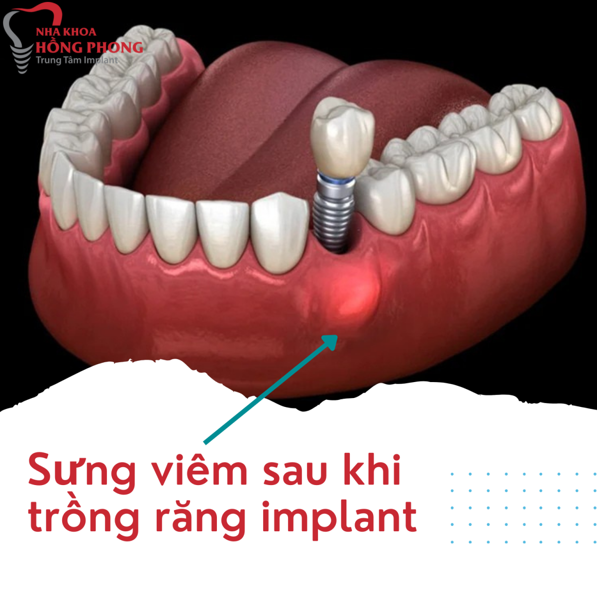 Sưng viêm sau khi trồng implant
