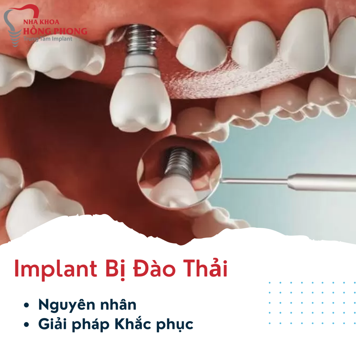 Implant Bị Đào Thải: Nguyên Nhân, Dấu Hiệu và Giải Pháp Khắc Phục Hiệu Quả