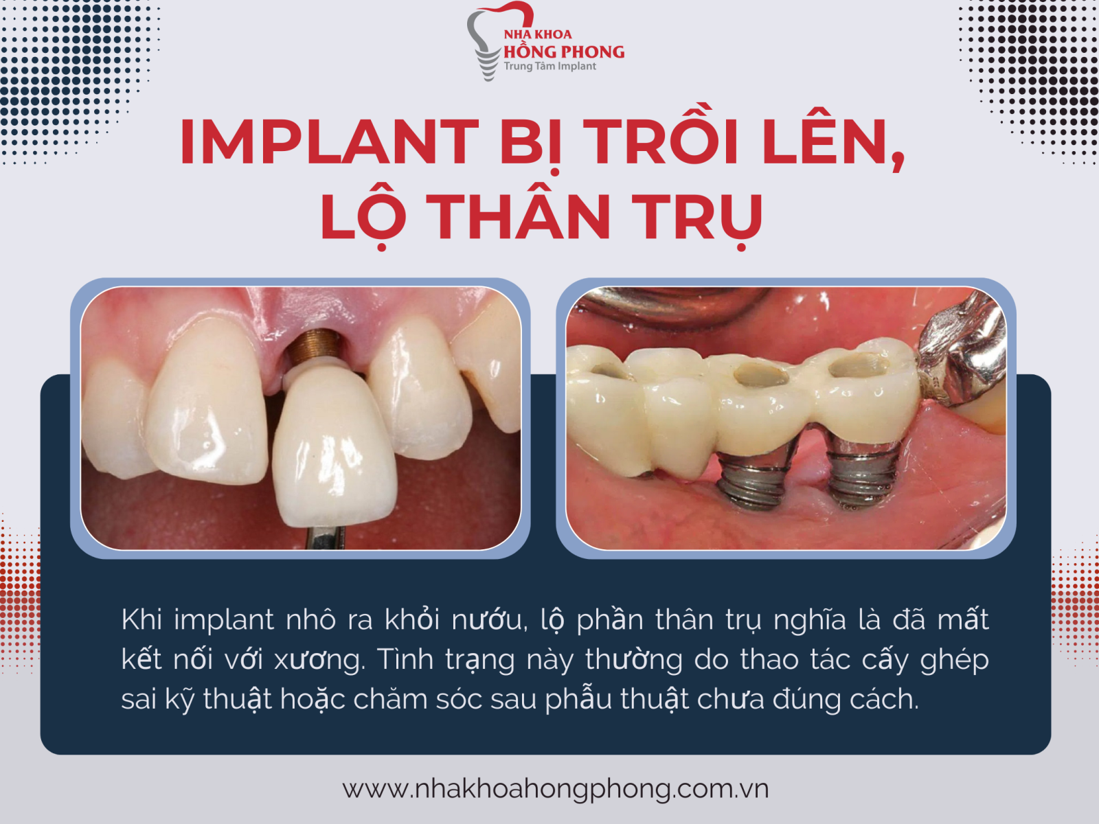 Trụ implant không tích hợp