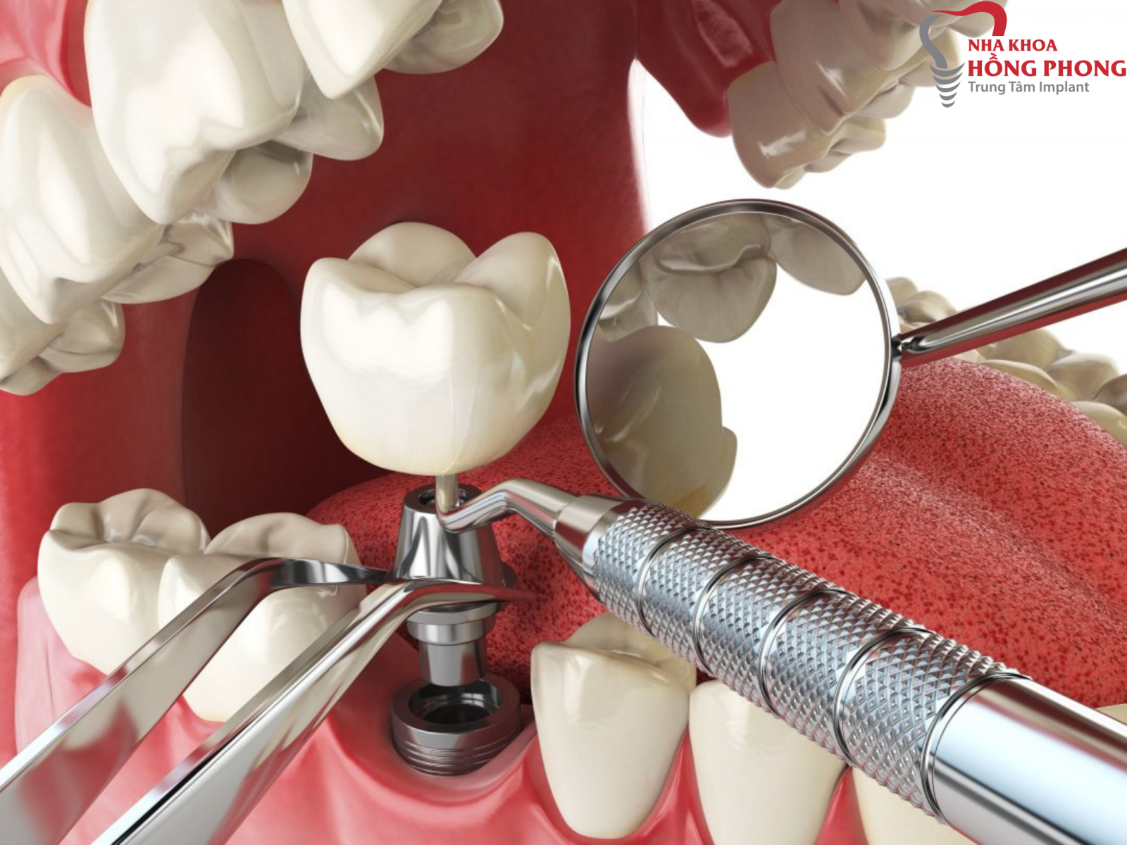 Trụ răng Implant bị lung lay